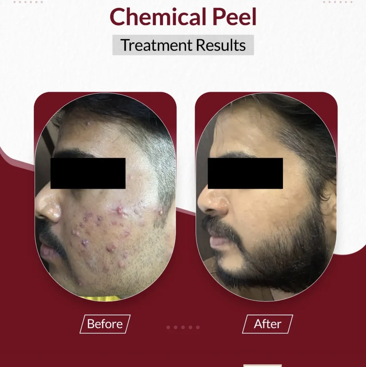 Acne Treatment (Chemical Peel) — before & after