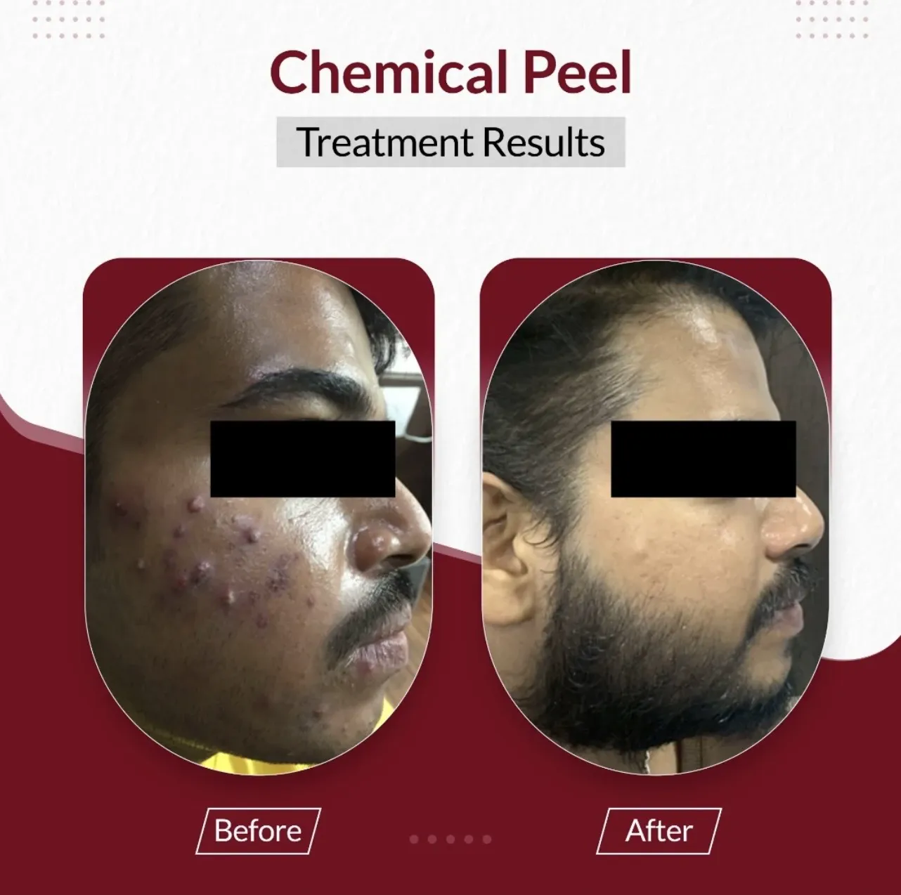 Acne Treatment — Side Profile — before & after