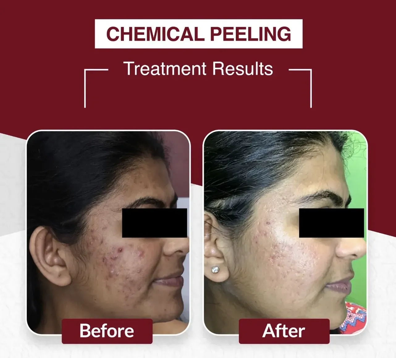Chemical Peeling — Side Profile — before & after