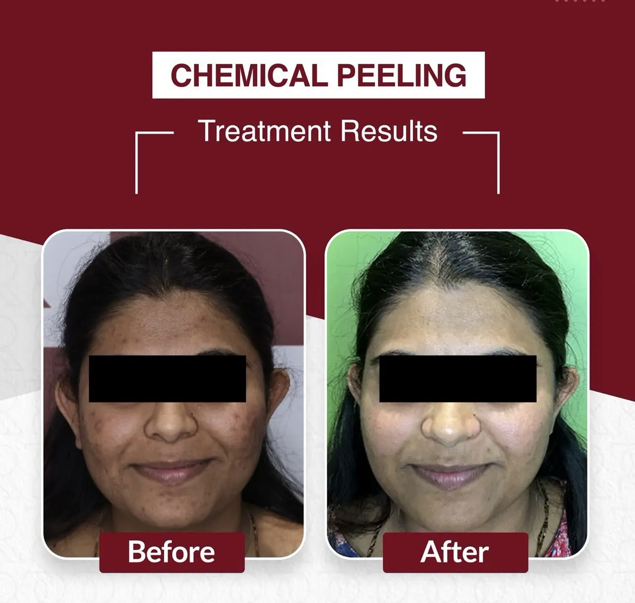 Chemical Peeling — Follow-up — before & after