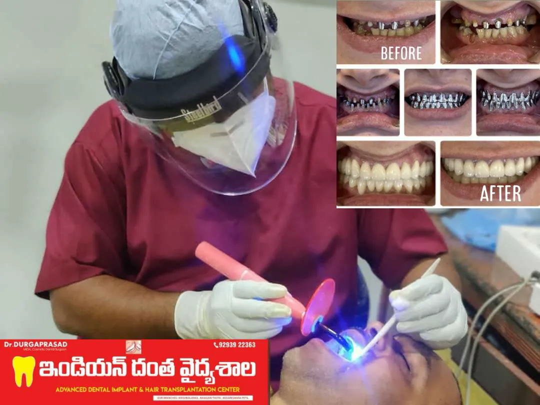 Full Mouth Rehabilitation — before & after