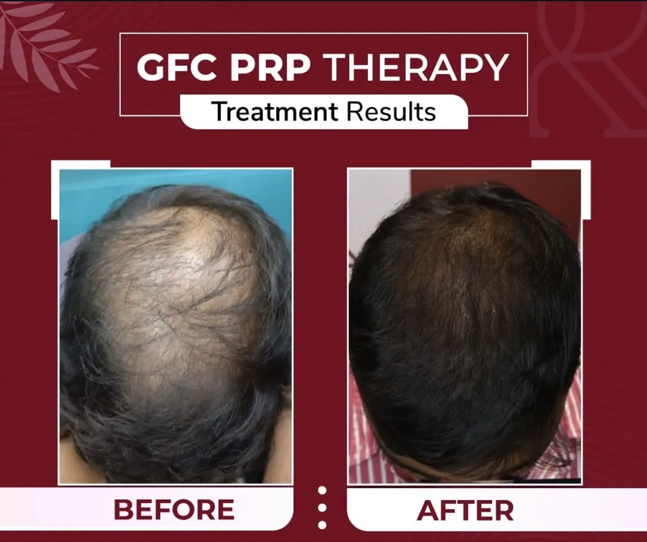 GFC + PRP Therapy — before & after
