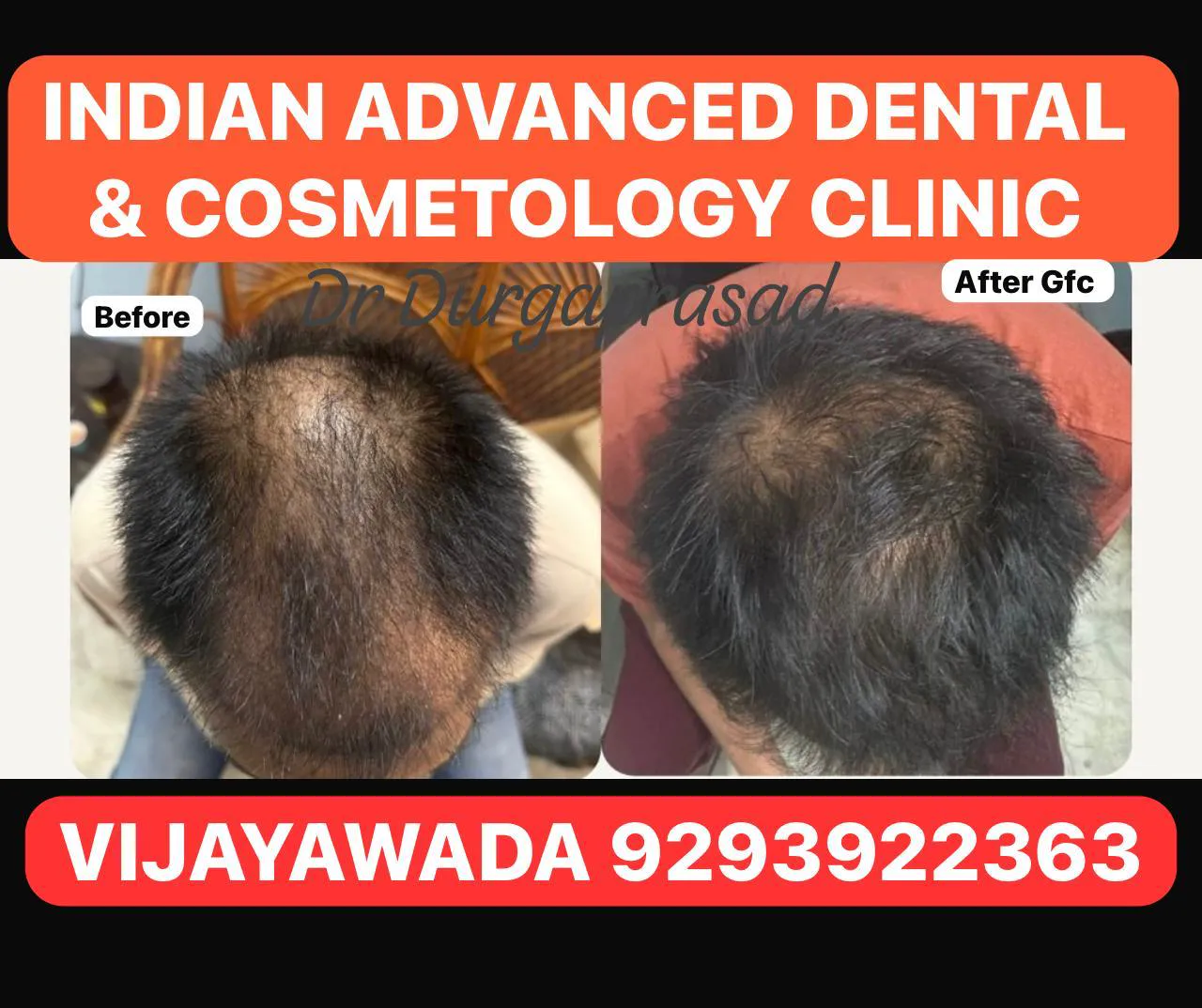GFC Hair Therapy — before & after