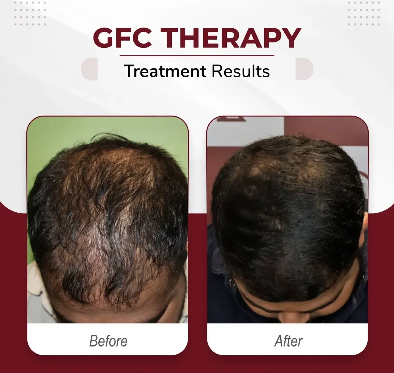 GFC Therapy — before & after