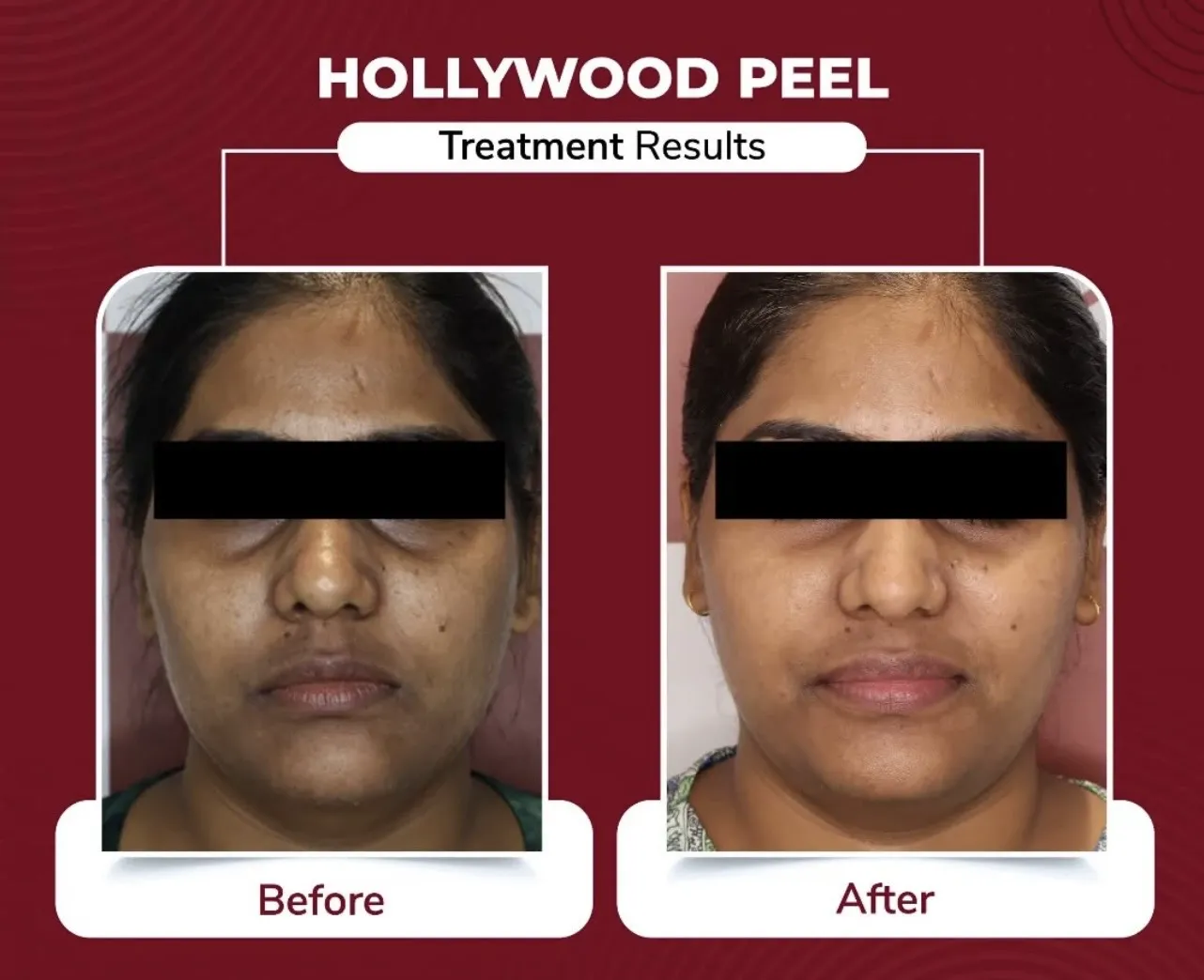 Hollywood Peel — before & after