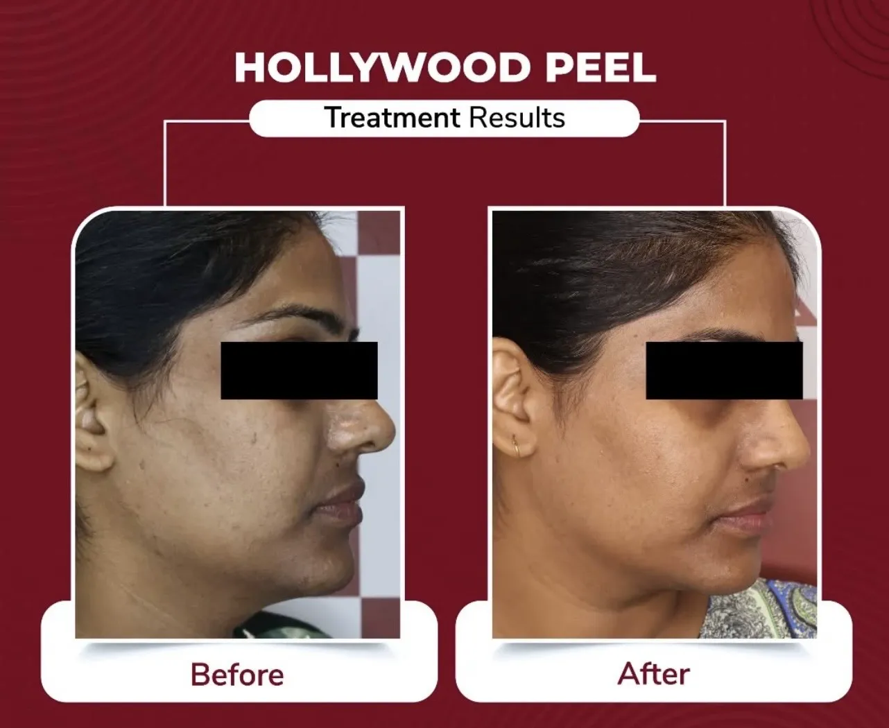 Hollywood Peel — Side Profile — before & after