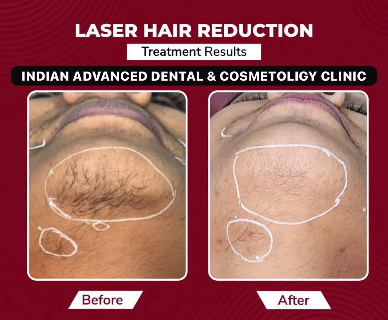 Laser Hair Reduction — Chin — before & after