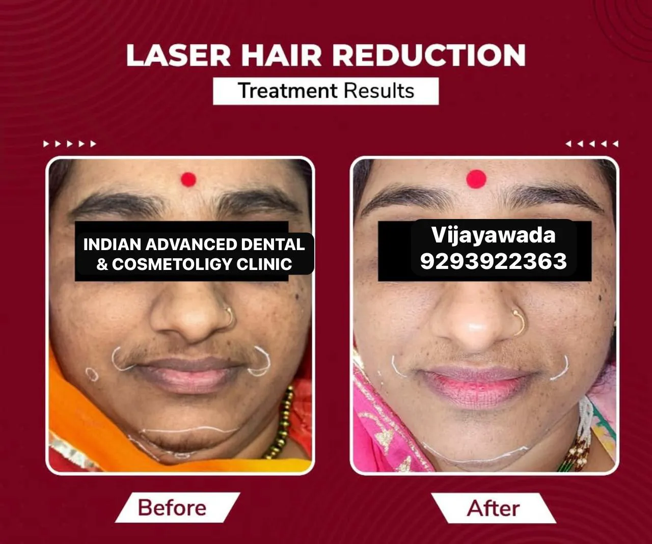 Laser Hair Reduction — Face — before & after