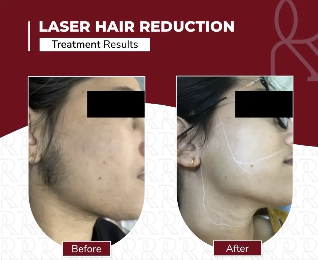 Laser Hair Reduction — before & after