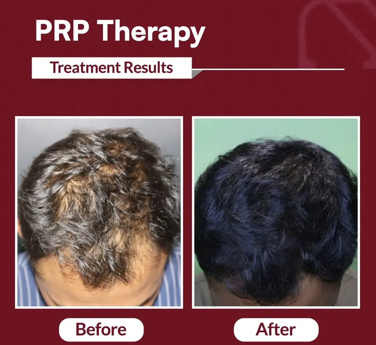 PRP Therapy — before & after