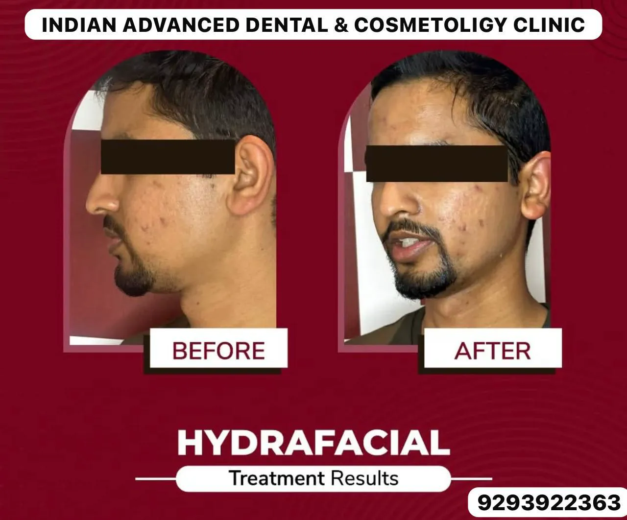 Pigmentation & Skin Rejuvenation