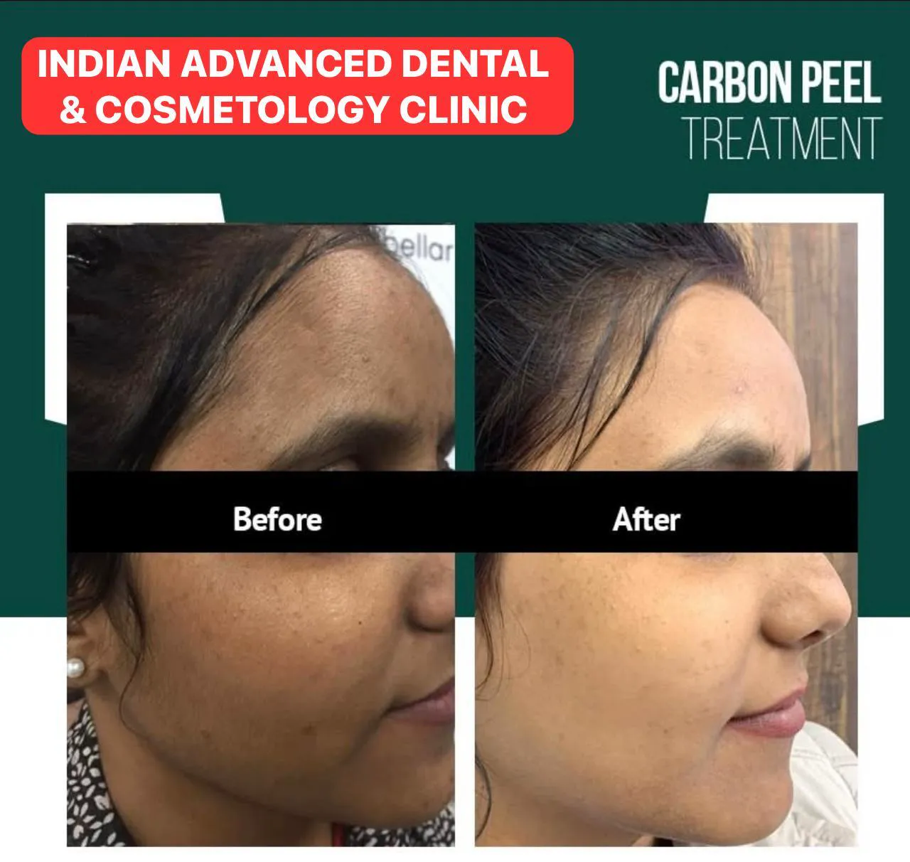 Laser Treatments